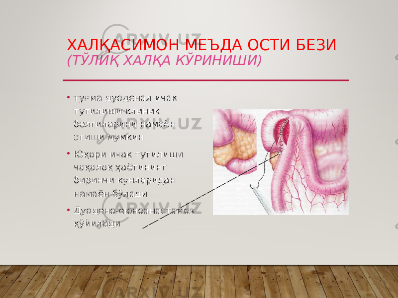 ХАЛҚАСИМОН МЕЪДА ОСТИ БЕЗИ (ТЎЛИҚ ХАЛҚА КЎРИНИШИ) • туғма дуоденал ичак тутилиши клиник белгиларини намаён этиши мумкин • Юқори ичак тутилиши чақалоқ ҳаётининг биринчи кунларидан намаён бўлади • Дуодено-еюноанастамоз қўйилади 