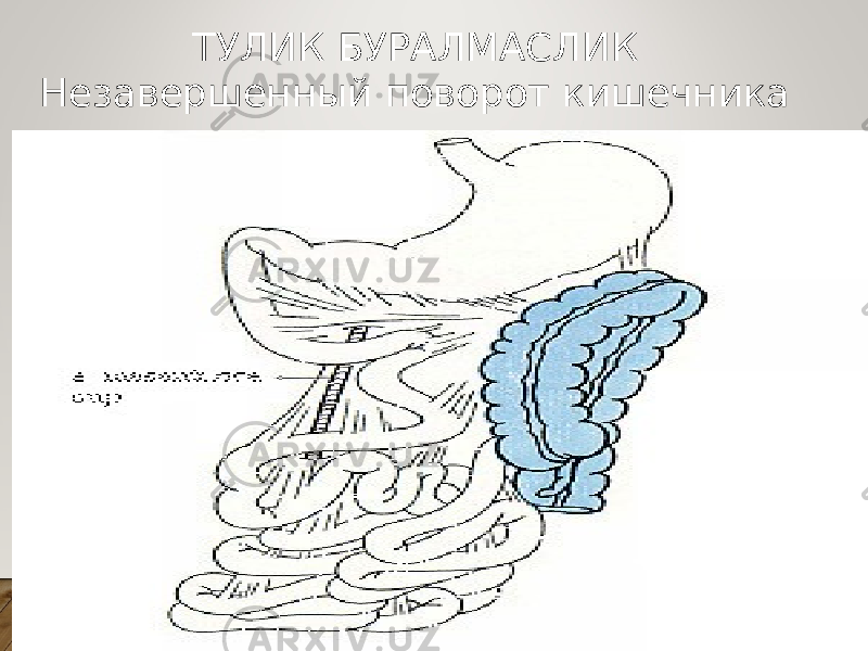 ТУЛИК БУРАЛМАСЛИК Незавершенный поворот кишечника 