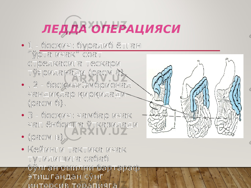 ЛЕДДА ОПЕРАЦИЯСИ • 1 - босқич: буралиб ётган “ўрта ичак” соат стрелкасига тескари тўғриланади (расм а). • . 2 - босқич: Эмбрионал чандиқлар қирқилади (расм б). • 3 - босқич: чамбар ичак чап ёнбошга ўтказилади • (расм в). • Кейинги тактика ичак тутилишига сабаб бўлган омилни бартараф этишгандан сўнг интерсив терапияга қаратилади 