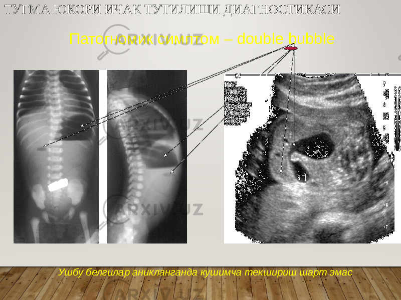 ТУГМА ЮКОРИ ИЧАК ТУТИЛИШИ ДИАГНОСТИКАСИ Патогномик симптом – double bubble Ушбу белгилар аникланганда кушимча текшириш шарт эмас 