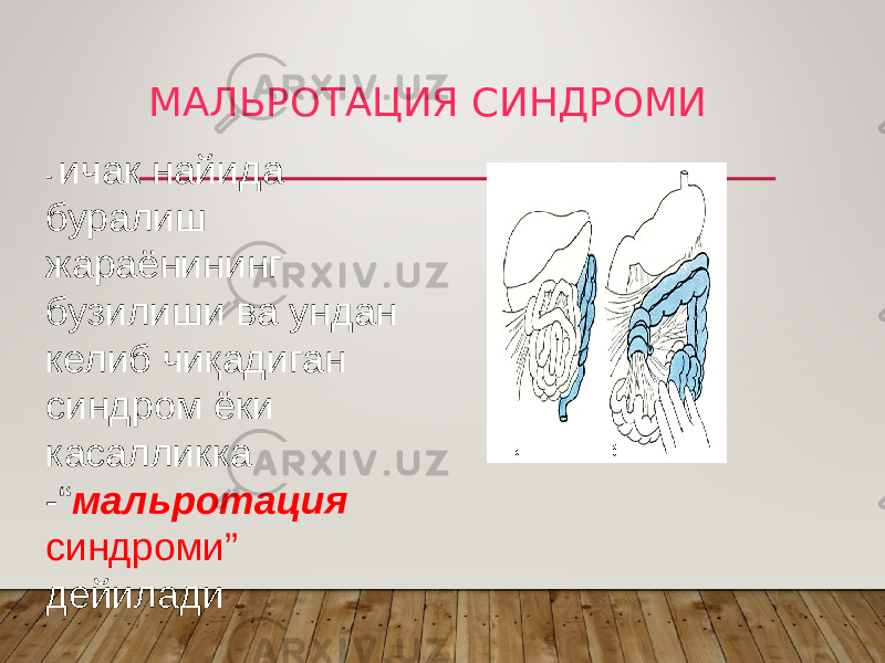 МАЛЬРОТАЦИЯ СИНДРОМИ - ичак найида буралиш жараёнининг бузилиши ва ундан келиб чиқадиган синдром ёки касалликка -“ мальротация синдроми” дейилади 