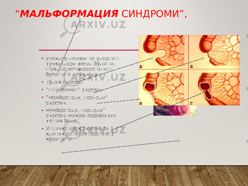 “ МАЛЬФОРМАЦИЯ СИНДРОМИ”, • ичаклар девори ва уларнинг тутқичлари ҳосил бўлиши, шаклланиш жараёнининг бузишига дейилади • Тўлиқ атрезия • “ шнурсимон” атрезия • “ мембранали, пардали” атрезия • мембранали, пардали” атрезия микроперфоритив тешик билан • Ингичка ичак атрезияси клиник (интраоперацион) кўриниши 