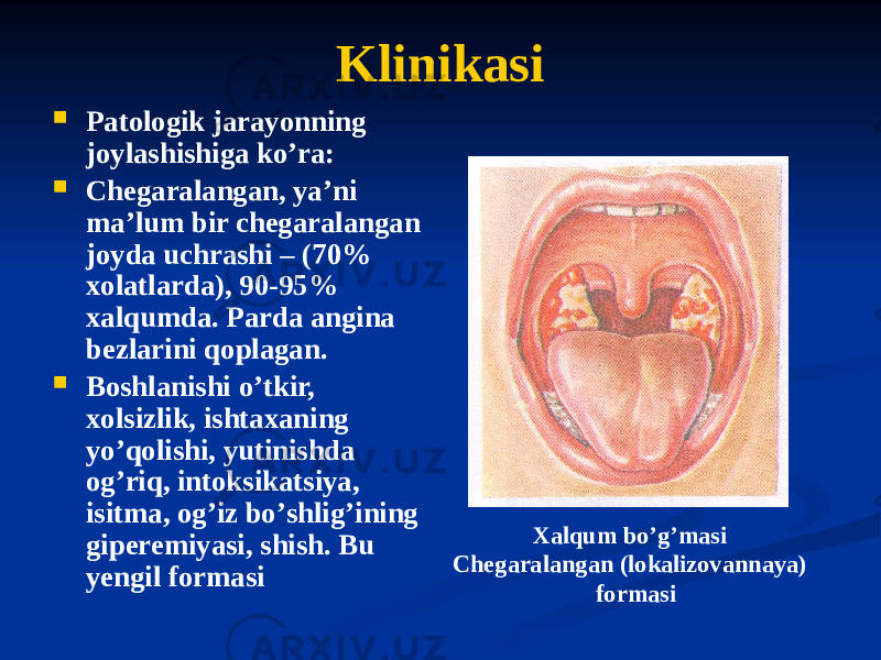 Klinikasi  Patologik jarayonning joylashishiga koʼra:  Chegaralangan, yaʼni maʼlum bir chegaralangan joyda uchrashi – (70% xolatlarda), 90-95% xalqumda. Parda angina bezlarini qoplagan.  Boshlanishi oʼtkir, xolsizlik, ishtaxaning yoʼqolishi, yutinishda ogʼriq, intoksikatsiya, isitma, ogʼiz boʼshligʼining giperemiyasi, shish. Bu yengil formasi Xalqum boʼgʼmasi Chegaralangan (lokalizovannaya) formasi 