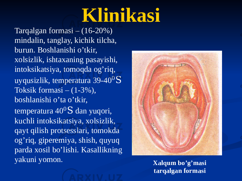 Klinikasi Tarqalgan formasi – (16-20%) mindalin, tanglay, kichik tilcha, burun. Boshlanishi oʼtkir, xolsizlik, ishtaxaning pasayishi, intoksikatsiya, tomoqda ogʼriq, uyqusizlik, temperatura 39-40 0 S Toksik formasi – (1-3%), boshlanishi oʼta oʼtkir, temperatura 40 0 S dan yuqori, kuchli intoksikatsiya, xolsizlik, qayt qilish protsesslari, tomokda ogʼriq, giperemiya, shish, quyuq parda xosil boʼlishi. Kasallikning yakuni yomon. Xalqum boʼgʼmasi tarqalgan formasi 