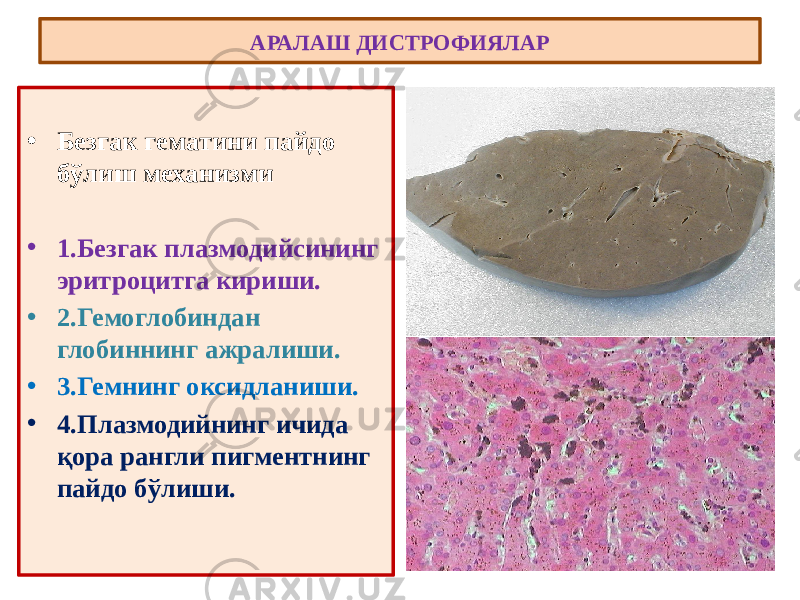 • Безгак гематини пайдо бўлиш механизми • 1.Безгак плазмодийсининг эритроцитга кириши. • 2.Гемоглобиндан глобиннинг ажралиши. • 3.Гемнинг оксидланиши. • 4.Плазмодийнинг ичида қора рангли пигментнинг пайдо бўлиши. АРАЛАШ ДИСТРОФИЯЛАР 