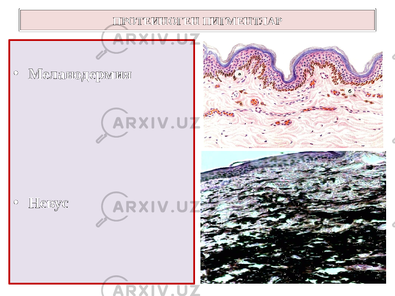 • Меланодермия • Невус ПРОТЕИНОГЕН ПИГМЕНТЛАР 
