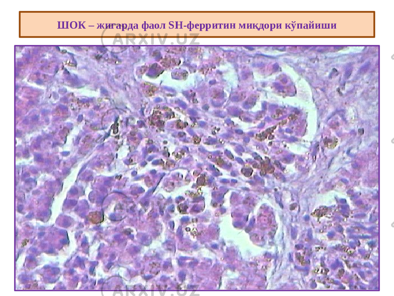 ШОК – жигарда фаол SH-ферритин миқдори кўпайиши 