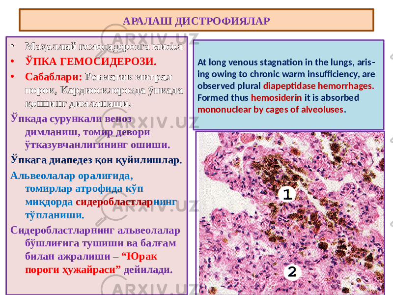 • Маҳаллий гемосидерозга мисол • ЎПКА ГЕМОСИДЕРОЗИ. • Сабаблари: Ревматик митрал порок, Кардиосклерозда ўпкада қоннинг димланиши. Ўпкада сурункали веноз димланиш, томир девори ўтказувчанлигининг ошиши. Ўпкага диапедез қон қуйилишлар. Альвеолалар оралиғида, томирлар атрофида кўп миқдорда сидеробластлар нинг тўпланиши. Сидеробластларнинг альвеолалар бўшлиғига тушиши ва балғам билан ажралиши – “Юрак пороги ҳужайраси” дейилади.АРАЛАШ ДИСТРОФИЯЛАР At long venous stagnation in the lungs, aris - ing owing to chronic warm insufficiency, are observed plural diapeptidase hemorrhages. Formed thus hemosiderin it is absorbed mononuclear by cages of alveoluses . 