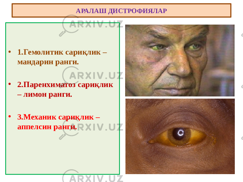 • 1.Гемолитик сариқлик – мандарин ранги. • 2.Паренхиматоз сариқлик – лимон ранги. • 3.Механик сариқлик – аппелсин ранги. АРАЛАШ ДИСТРОФИЯЛАР 