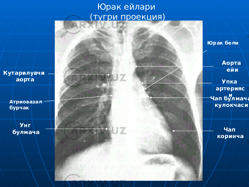 Юрак ейлари (тугри проекция) Кутарилувчи аорта Унг булмача Аорта ейи Упка артерияс и Чап булмача кулокчаси Чап коринчаАтриовазал бурчак Юрак бели 