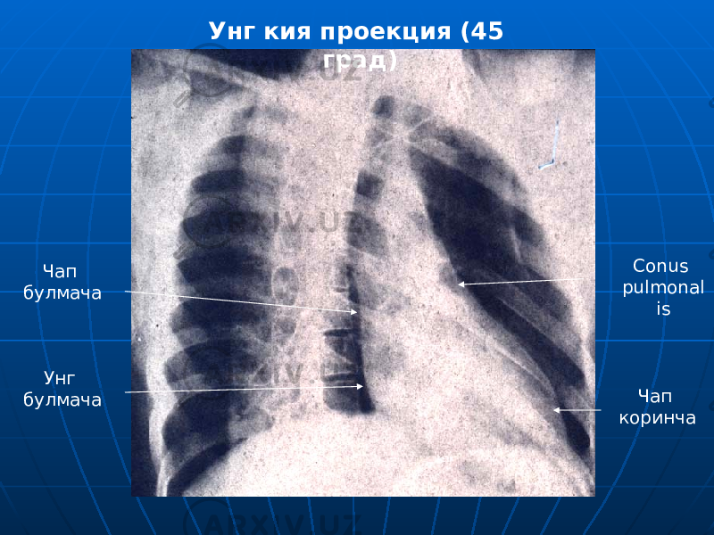 Чап булмача Унг булмача Conus pulmonal is Чап коринчаУнг кия проекция (45 град) 