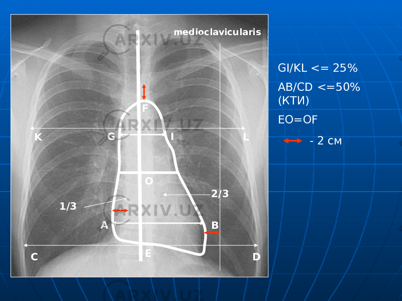 1/3 2/3 A B C DO EF G I K Lmedioclavicularis - 2 смGI/KL <= 25% AB/CD <=50% (КТИ) EO=OF 