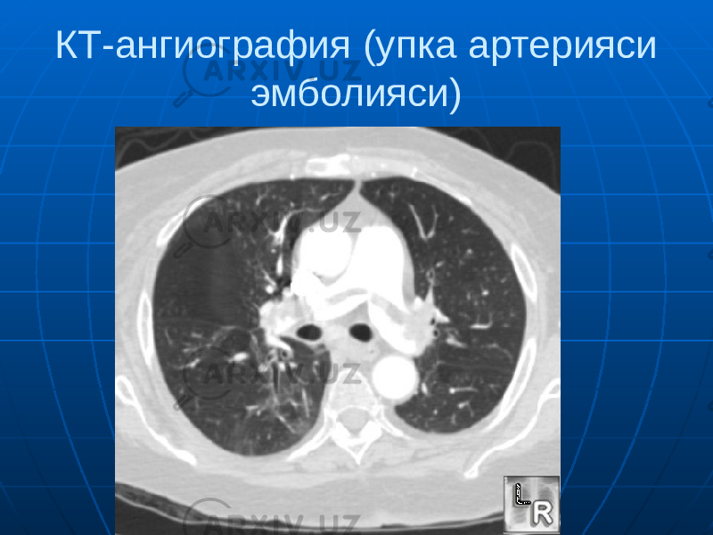 КТ-ангиография (упка артерияси эмболияси) 