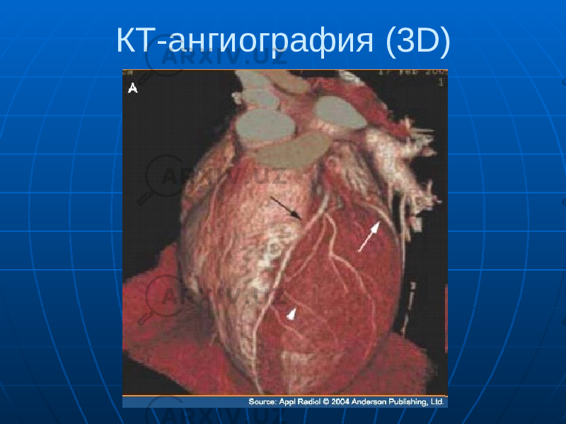 КТ-ангиография (3D) 