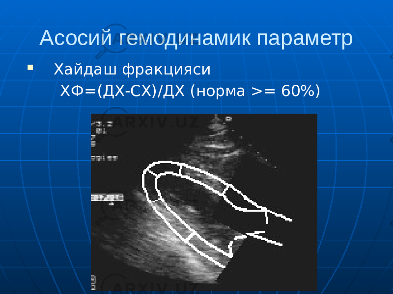 Асосий гемодинамик параметр  Хайдаш фракцияси ХФ=(ДХ-СХ)/ДХ (норма >= 60%) 