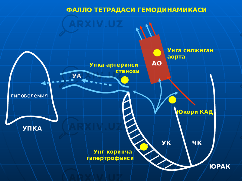 гиповолемия УПКА ЮРАКУК ЧКАО Унга силжиган аорта Упка артерияси стенози Унг коринча гипертрофияси Юкори КАДУАФАЛЛО ТЕТРАДАСИ ГЕМОДИНАМИКАСИ 