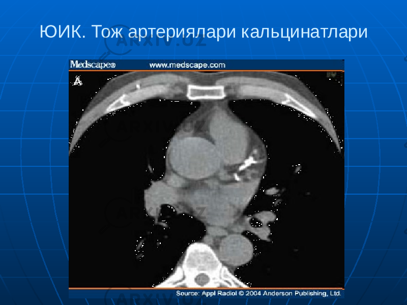 ЮИК. Тож артериялари кальцинатлари 