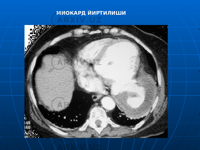 МИОКАРД ЙИРТИЛИШИ 
