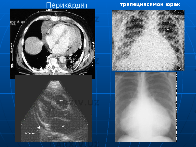 Перикардит трапециясимон юрак 