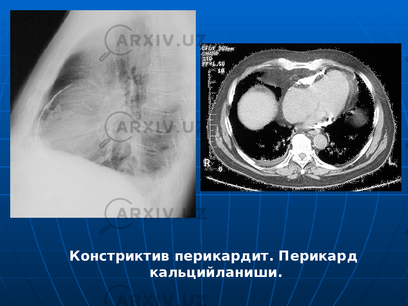 Констриктив перикардит. Перикард кальцийланиши. 