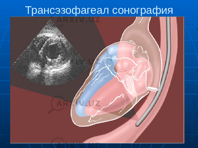 Трансэзофагеал сонография 