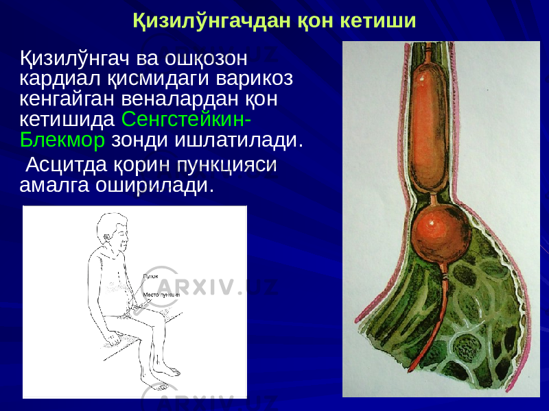 Қизилўнгачдан қон кетиши Қизилўнгач ва ошқозон кардиал қисмидаги варикоз кенгайган веналардан қон кетишида Сенгстейкин- Блекмор зонди ишлатилади. Асцитда қорин пункцияси амалга оширилади. 