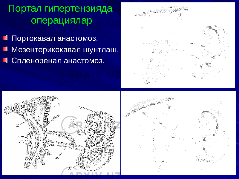 Портал гипертензияда операциялар Портокавал анастомоз. Мезентерикокавал шунтлаш. Спленоренал анастомоз. 