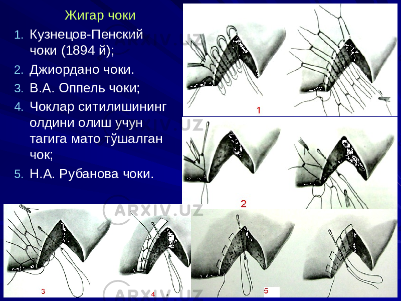 Жигар чоки 1. Кузнецов-Пенский чоки (1894 й); 2. Джиордано чоки. 3. В.А. Оппель чоки; 4. Чоклар ситилишининг олдини олиш учун тагига мато тўшалган чок; 5. Н.А. Рубанова чоки. 