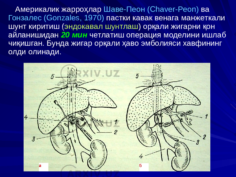  Америкалик жарроҳлар Шаве-Пеон (Chaver-Peon) ва Гонзалес (Gonzales, 1970) пастки кавак венага манжеткали шунт киритиш ( эндокавал шунтлаш ) орқали жигарни қон айланишидан 20 мин четлатиш операция моделини ишлаб чиқишган. Бунда жигар орқали ҳаво эмболияси хавфининг олди олинади. 