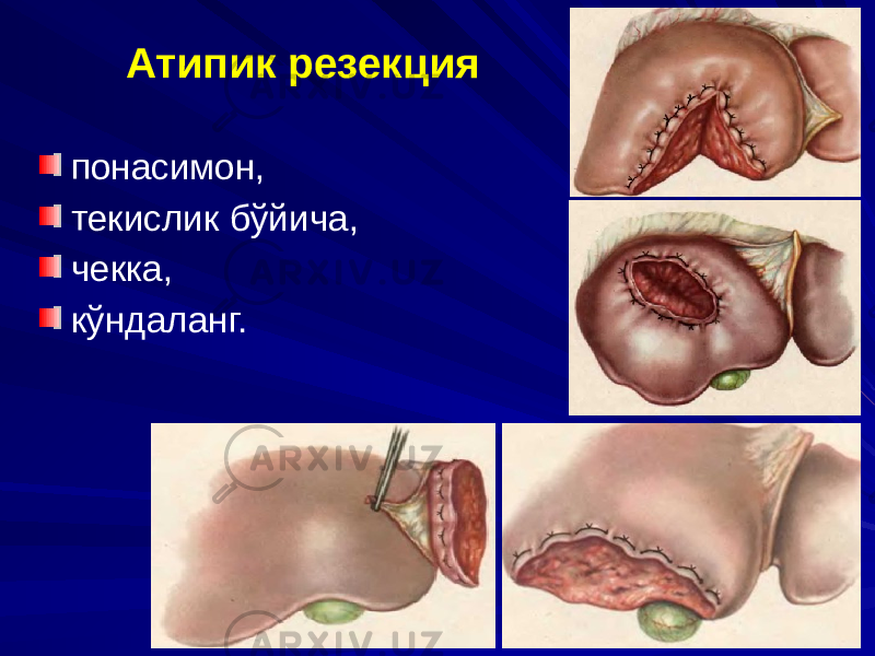 Атипик резекция понасимон, текислик бўйича, чекка, кўндаланг. 