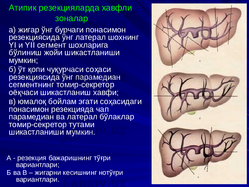 Атипик резекцияларда хавфли зоналар а) жигар ўнг бурчаги понасимон резекциясида ўнг латерал шохнинг YI и YII сегмент шохларига бўлиниш жойи шикастланиши мумкин; б) ўт қопи чуқурчаси соҳаси резекциясида ўнг парамедиан сегментнинг томир-секретор оёқчаси шикастланиш хавфи; в) юмалоқ бойлам эгати соҳасидаги понасимон резекцияда чап парамедиан ва латерал бўлаклар томир-секретор тутами шикастланиши мумкин. А - резекция бажаришнинг тўғри вариантлари; Б ва В – жигарни кесишнинг нотўғри вариантлари. 