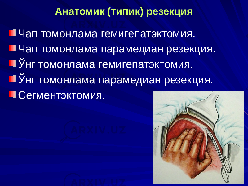 Анатомик (типик) резекция Чап томонлама гемигепатэктомия. Чап томонлама парамедиан резекция. Ўнг томонлама гемигепатэктомия. Ўнг томонлама парамедиан резекция. Сегментэктомия. 