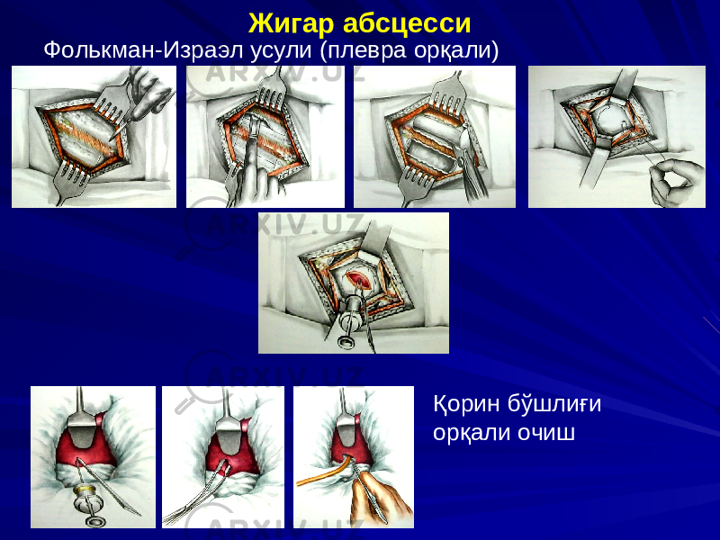 Жигар абсцесси Фолькман-Израэл усули (плевра орқали) Қорин бўшлиғи орқали очиш 