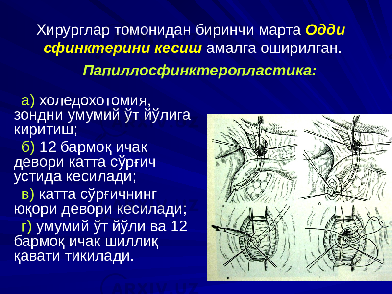 Хирурглар томонидан биринчи марта Одди сфинктерини кесиш амалга оширилган. а) холедохотомия, зондни умумий ўт йўлига киритиш; б) 12 бармоқ ичак девори катта сўрғич устида кесилади; в) катта сўрғичнинг юқори девори кесилади; г) умумий ўт йўли ва 12 бармоқ ичак шиллиқ қавати тикилади. Папиллосфинктеропластика: 