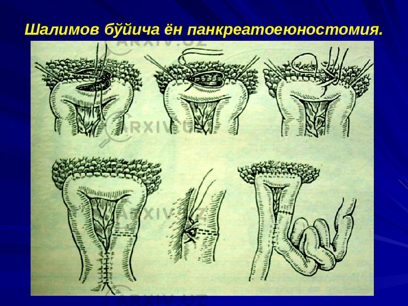 Шалимов бўйича ён панкреатоеюностомия. 