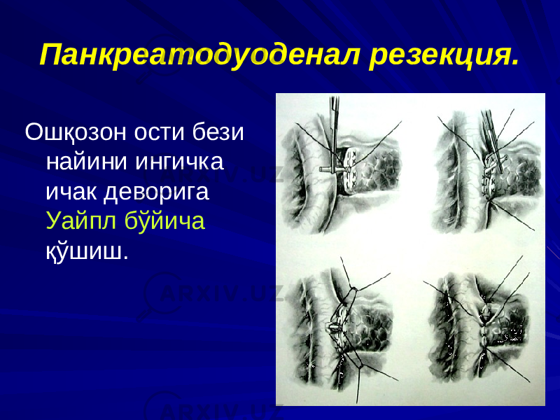 Панкреатодуоденал резекция. Ошқозон ости бези найини ингичка ичак деворига Уайпл бўйича қўшиш. 