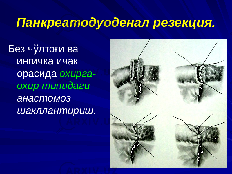 Панкреатодуоденал резекция. Без чўлтоғи ва ингичка ичак орасида охирга- охир типидаги анастомоз шакллантириш . 