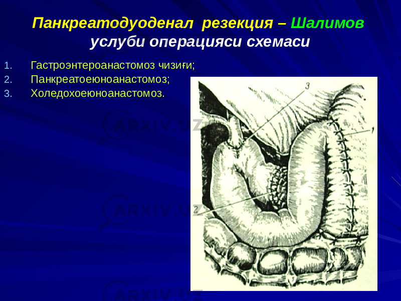 Панкреатодуоденал резекция – Шалимов услуби операцияси схемаси 1. Гастроэнтероанастомоз чизиғи; 2. Панкреатоеюноанастомоз; 3. Холедохоеюноанастомоз. 