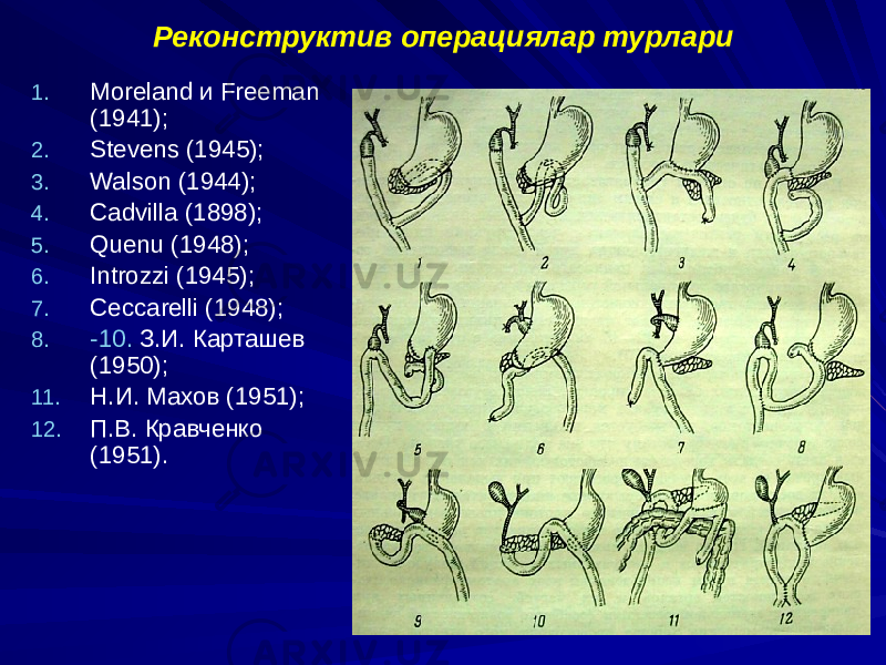 Реконструктив операциялар турлари 1. Moreland и Freeman (1941); 2. Stevens (1945); 3. Walson (1944); 4. Cadvilla (1898); 5. Quenu (1948); 6. Introzzi (1945); 7. Ceccarelli (1948); 8. -10. З.И. Карташев (1950); 11. Н.И. Махов (1951); 12. П.В. Кравченко (1951). 