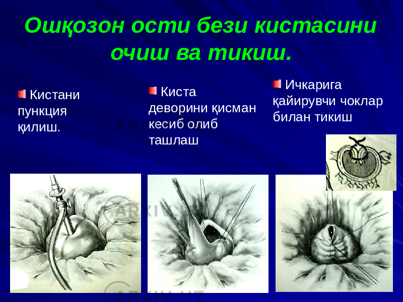 Ошқозон ости бези кистасини очиш ва тикиш. Киста деворини қисман кесиб олиб ташлаш Ичкарига қайирувчи чоклар билан тикиш Кистани пункция қилиш. 