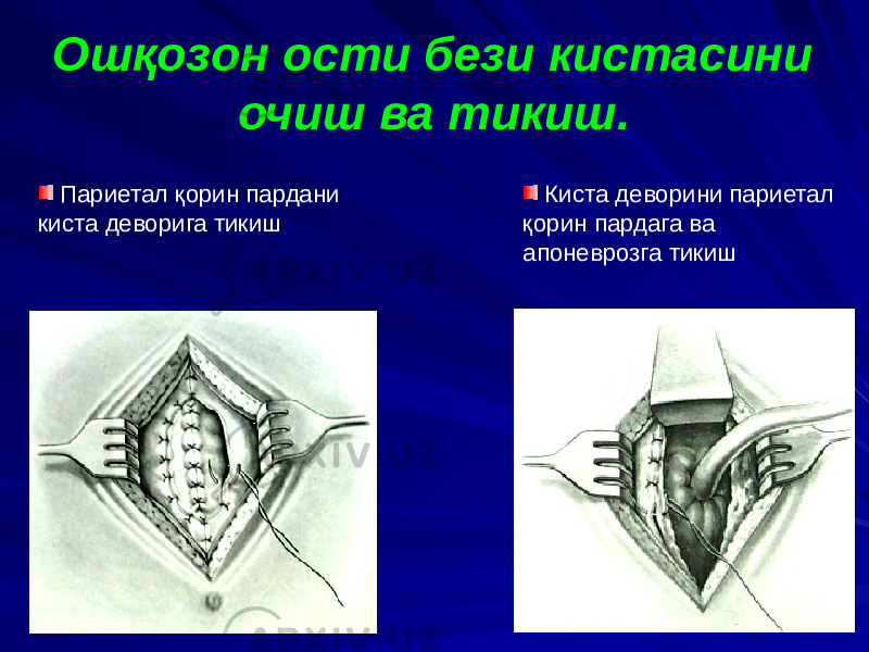 Ошқозон ости бези кистасини очиш ва тикиш. Париетал қорин пардани киста деворига тикиш Киста деворини париетал қорин пардага ва апоневрозга тикиш 