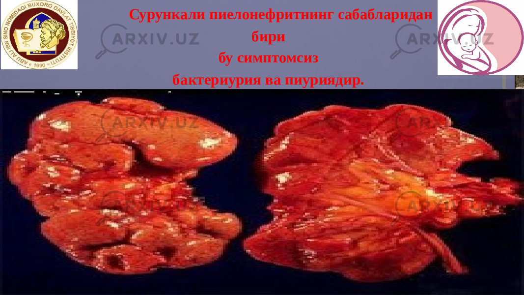  Сурункали пиелонефритнинг сабабларидан бири бу симптомсиз бактериурия ва пиуриядир. 