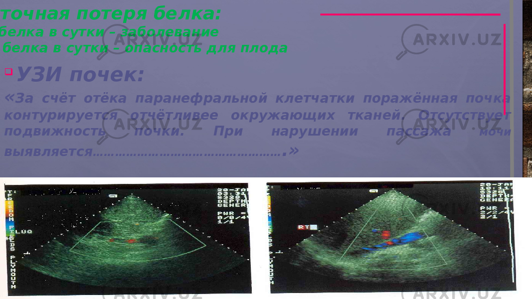   суточная потеря белка:  2 г белка в сутки – заболевание 4-5 г белка в сутки – опасность для плода  УЗИ почек: « За счёт отёка паранефральной клетчатки поражённая почка контурируется отчётливее окружающих тканей. Отсутствует подвижность почки. При нарушении пассажа мочи выявляется …………………………………………… .» 