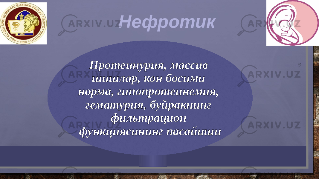 50Протеинурия, массив шишлар, кон босими норма, гипопротеинемия, гематурия, буйракнинг фильтрацион функциясининг пасайиши Нефротик 