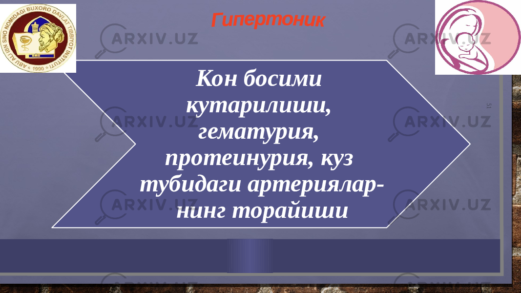 51Кон босими кутарилиши, гематурия, протеинурия, куз тубидаги артериялар- нинг торайиши 