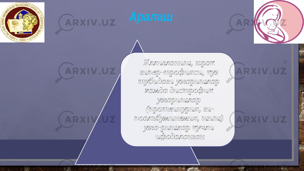 52Яллигланиш, юрак гипер-трофияси, куз тубидаги узгаришлар хамда дистрофик узгаришлар (протеинурия, ги- поальбуминемия, шиш) узга-ришлар кучли ифодаланган 