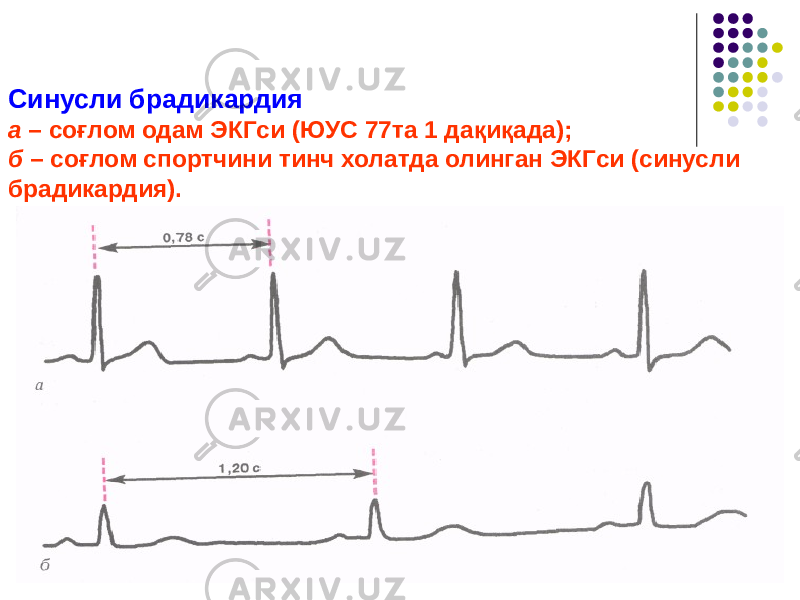 Синусли брадикардия а – соғлом одам ЭКГси (ЮУС 77та 1 дақиқада); б – соғлом спортчини тинч холатда олинган ЭКГси (синусли брадикардия). 