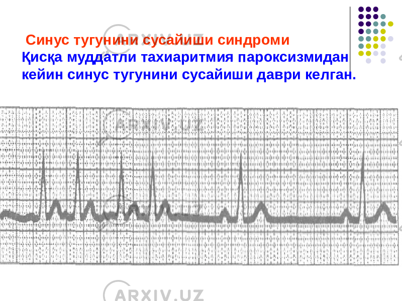  Синус тугунини сусайиши синдроми Қисқа муддатли тахиаритмия пароксизмидан кейин синус тугунини сусайиши даври келган. 