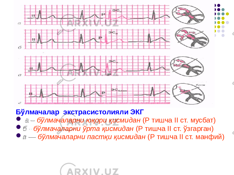 Бўлмачалар экстрасистолияли ЭКГ  а – бўлмачаларни юқори қисмидан (Р тишча II ст. мусбат)  б - бўлмачаларни ўрта қисмидан (Р тишча II ст. ўзгарган)  в — бўлмачаларни пастқи қисмидан (Р тишча II ст. манфий) 
