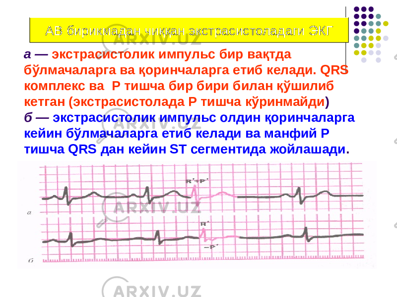 а — экстрасистолик импульс бир вақтда бўлмачаларга ва қоринчаларга етиб келади. QRS комплекс ва Р тишча бир бири билан қўшилиб кетган (экстрасистолада Р тишча кўринмайди ) б — экстрасистолик импульс олдин қоринчаларга кейин бўлмачаларга етиб келади ва манфий Р тишча QRS дан кейин ST сегментида жойлашади .АВ бирикмадан чиққан экстрасистоладаги ЭКГ 